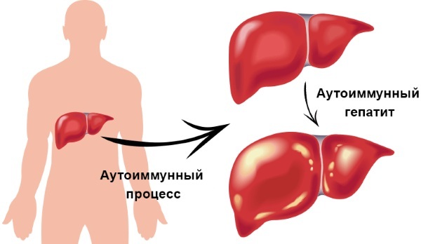 Cirrhosis of the liver. Symptoms in women, men, diagnosis, causes, drug treatment