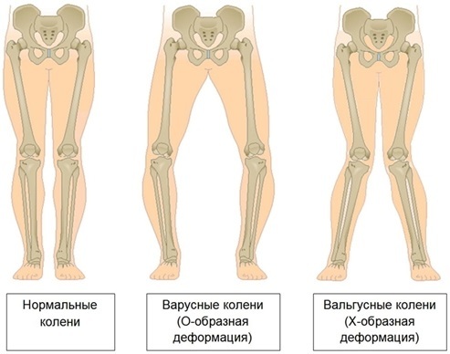 Koślawe kolana deformacji u dzieci z kciuka. Obraz co to jest zakres, przyczyny. Chirurgia, ćwiczenia, masaże