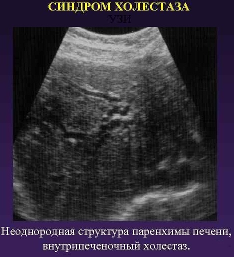 Cholestazė nėštumo metu. Kas tai yra vėlyvose, ankstyvosiose stadijose, simptomai, gydymas