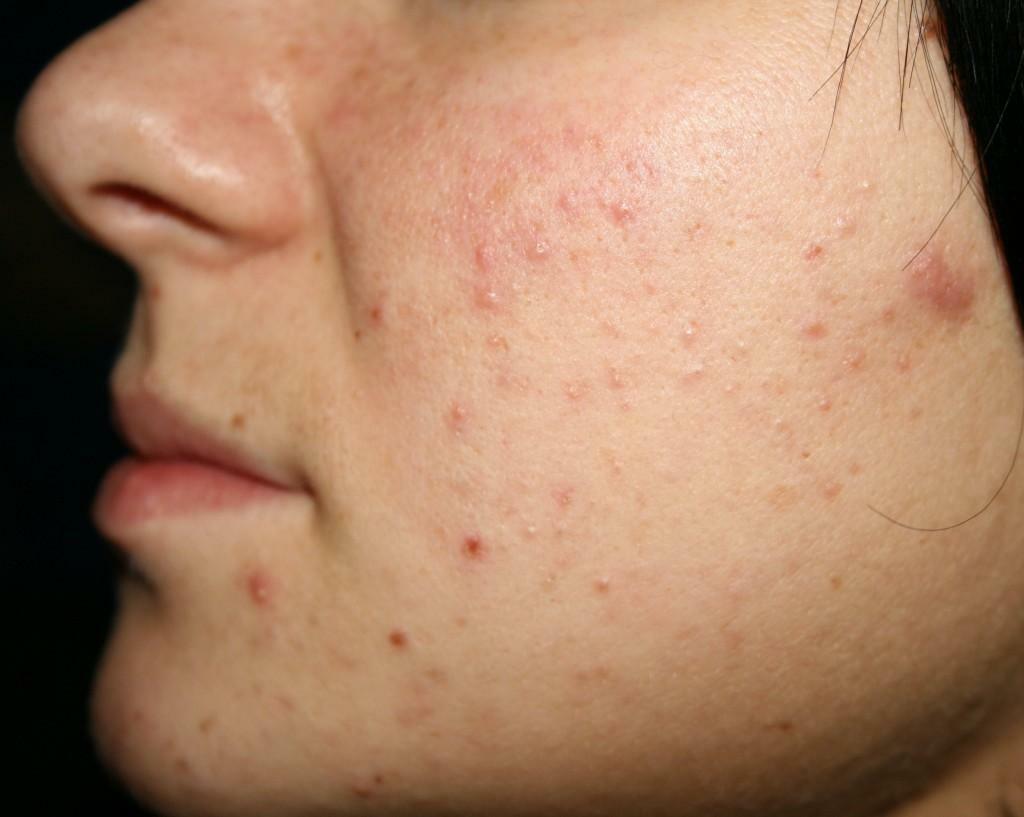Hormonal imbalance - one of the reasons for the appearance of pimples on the cheeks