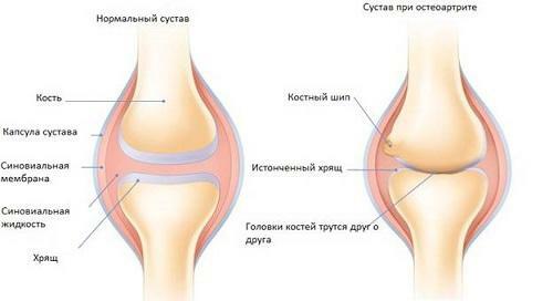 Articulação da artrite