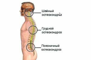 סוגים של osteochondrosis