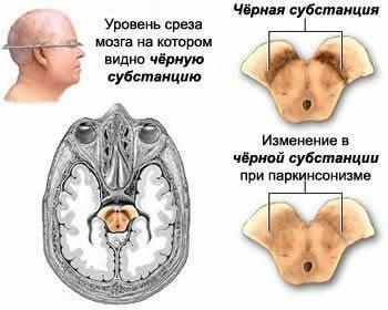 Modificări ale creierului