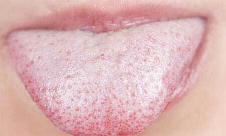 Oral candidoză: simptome și tratament la adulți
