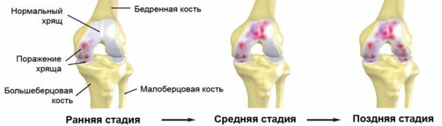 Causes, symptoms and treatment of knee osteoarthritis