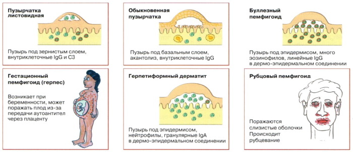 Pemphigus vulgaris: diferenciāldiagnoze, klīniskās vadlīnijas