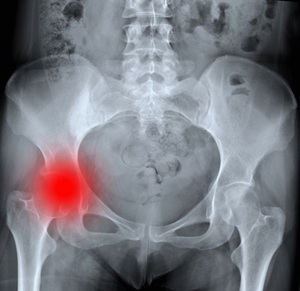 Arthrose déformante( coxarthrose) de l'articulation de la hanche 1, 2, 3 degrés