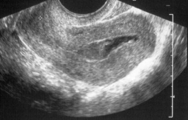 HCG z nieudanego aborcji postać we wczesnych stadiach, może wzrastać lub nie spada tak szybko, stół, obniża poziom