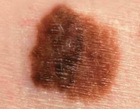 Početni stadij fotografije karcinoma kože