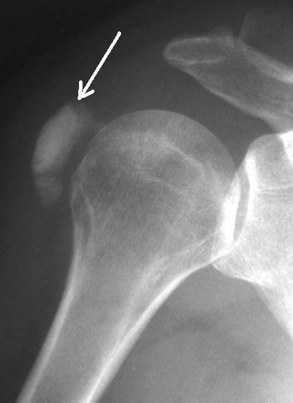Tendonitis on X-ray