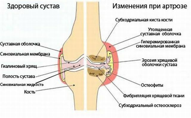arthrosis of the knees