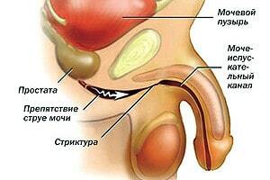 Urethrale strictuur
