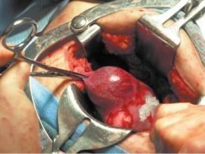 Kirurgisk behandling för tubal ektopisk graviditet