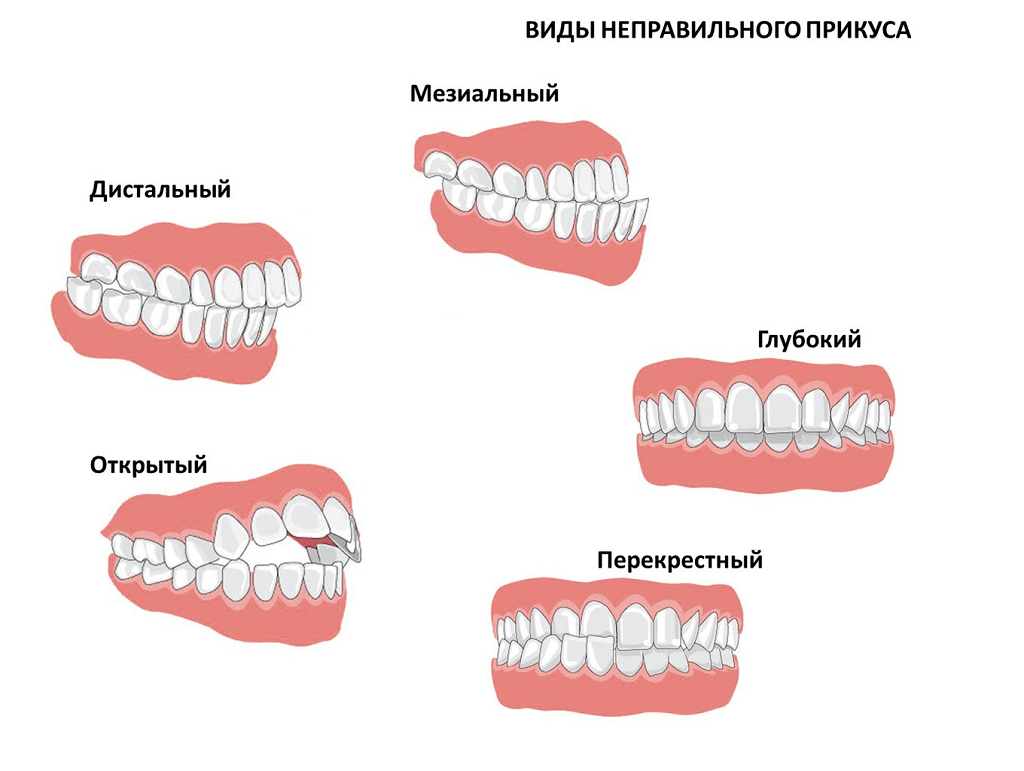 Visual representation of the types of malocclusion