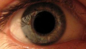 pupillary poremećaj