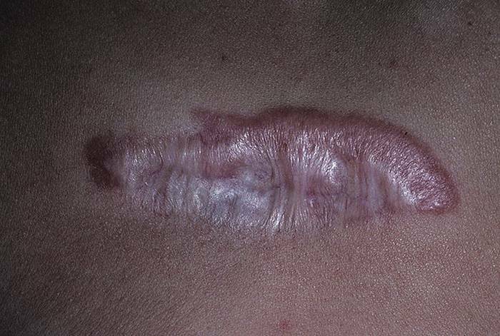 Cicatrices chéloïdes: causes, traitement, élimination