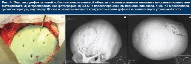 Cranioplasty - operation for correction of skull defects