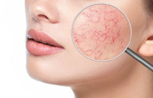 Capillaries on the face. How to clean with pharmacy products, ointment, tablets