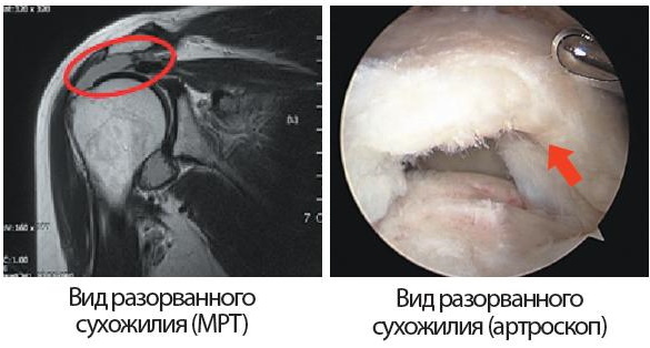 Ruptur av senen i supraspinatus -muskelen i skulderleddet