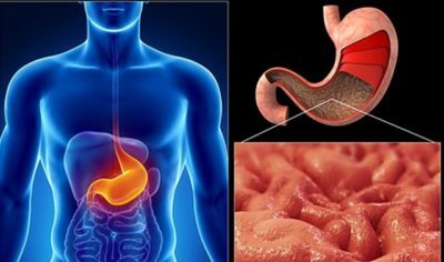 Atrophic gastritis: symptoms and treatment with the most effective folk remedies