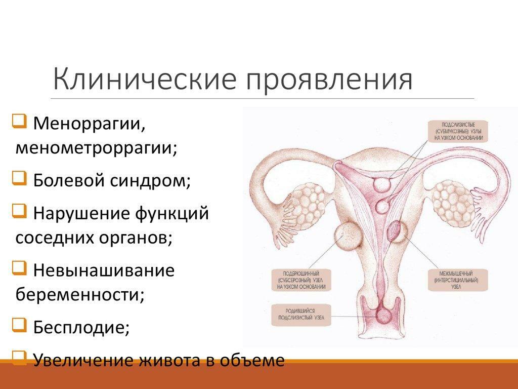 Kliniske manifestationer af uterine myoma