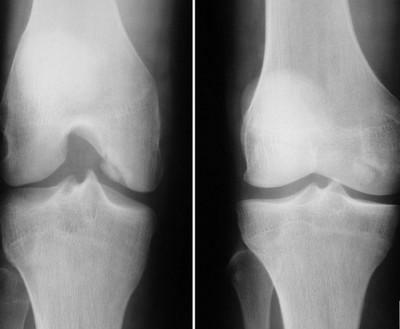 Imagine cu raze X a articulației genunchiului