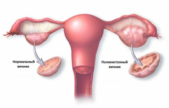 Pregnancy in polycystic ovary