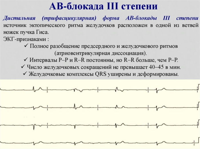 AV (atrioventricular) dissociation on the ECG. What does this mean, signs in a child, young%