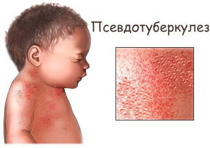 Pseudotuberculoză și yersinioză. Diagnostic diferentiat
