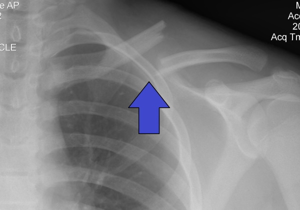 Fracture of the clavicle. Treatment at home, terms of rehabilitation
