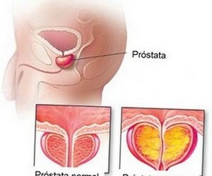 Prostatitida a rozdíly v prostatitidě.