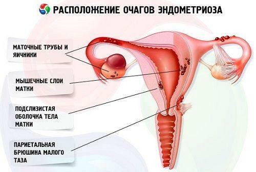 Endometrioosin kärkipaikan sijainti