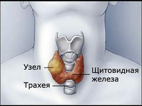 Kronični autoimuni tiroiditis