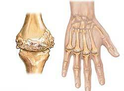 Reumatoid arthritis - hvad er det?