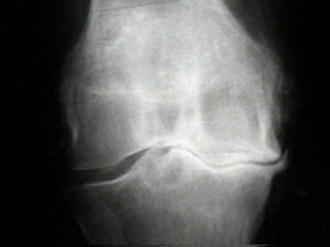 Röntgenfoto van het kniegewricht