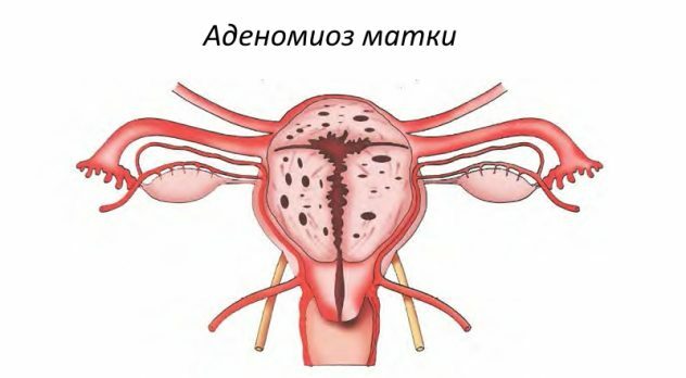 Pregnancy in adenomyosis of the uterus