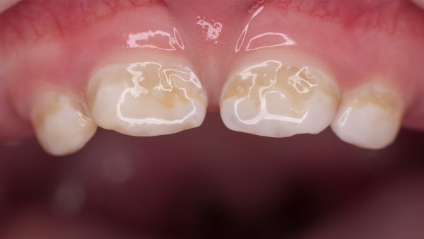 Remineraliserende gel til tænder til børn. Hvilket er bedre, anmeldelser
