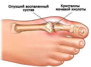 Gouty artritis van de vinger