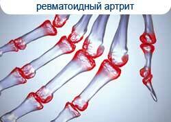 The first signs of rheumatoid arthritis