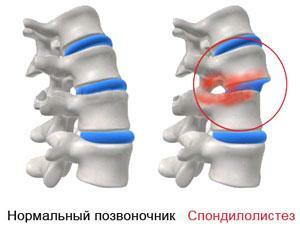 Spostamento delle vertebre
