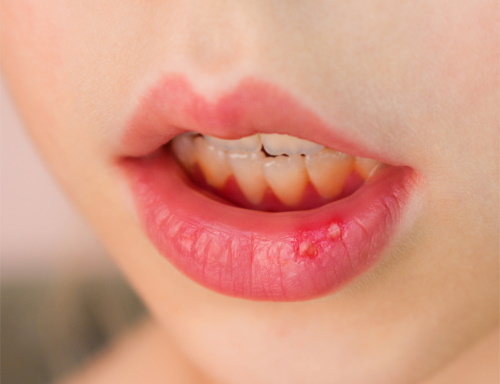 Stomatitis in the mouth in children. Means for treatment, drugs