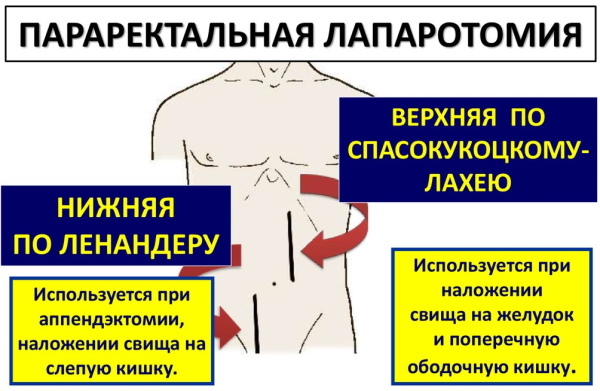 Appendectomy according to Volkovich-Dyakonov by pararectal incision according to Lenander