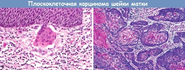 Gimdos kaklelio plokščiųjų ląstelių karcinoma, turinti polinkį keratinizacijai. Kas tai yra, simptomai, prognozė, gydymas
