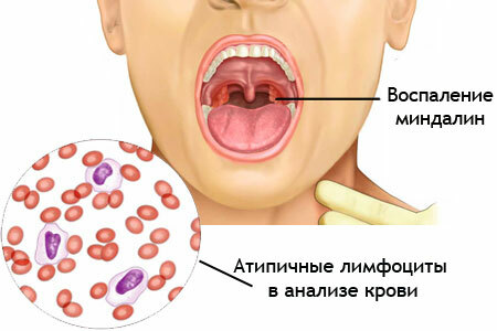 Symptoms of infectious mononucleosis