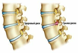 spinal traktion
