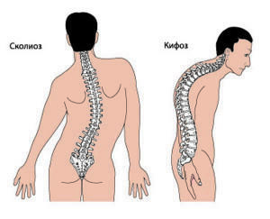 Scoliosis( displacement of the spine)