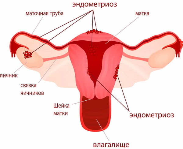 The ovary on the left hurts. Causes in women before, during menstruation
