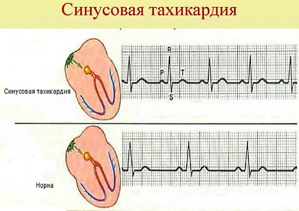 Tachycardia. Symptoms and treatment of paroxysmal, ventricular, supraventricular, sinus. Diagnostics that can not be done