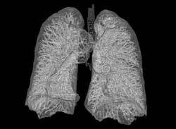 komplikationer af pulmonal pneumosklerose