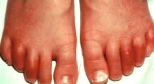 artrose van de vingers